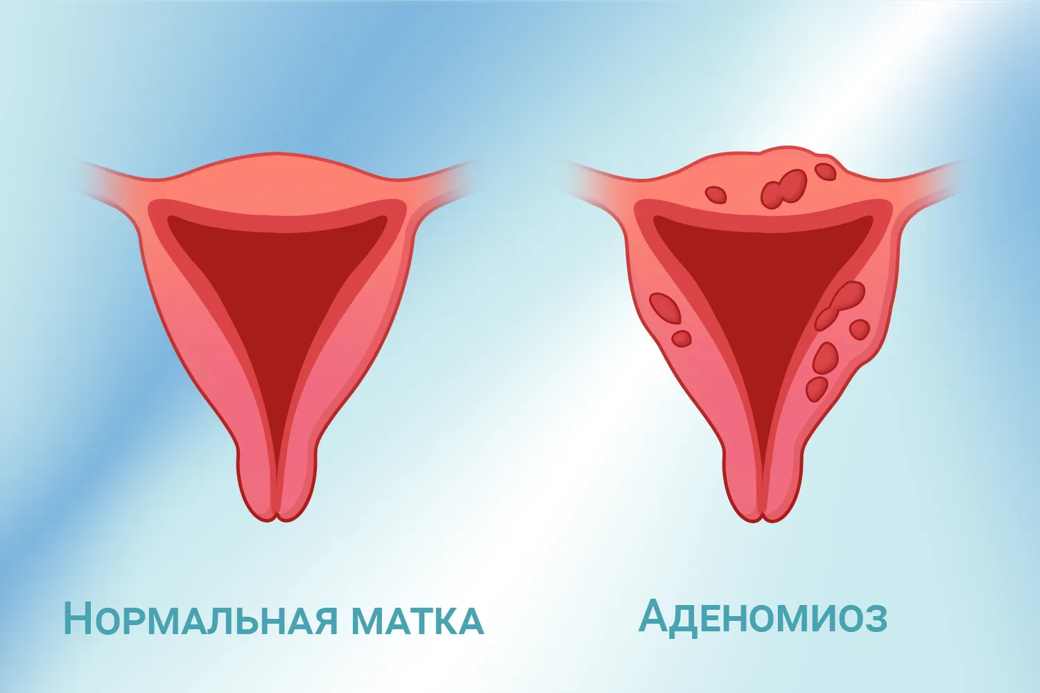 Нормальная матка и матка, измененная аденомиозом